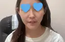 クマ治療 WOM CLINIC GINZA （ワム クリニック ギンザ） AFTER サムネイル用