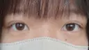 二重埋没 ルラ美容クリニック 渋谷本院 DAY 13 サムネイル用
