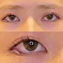 目尻切開 / タレ目形成・グラマラスライン（埋没） / 美容点滴・美容注射（美肌） LOUIS CLINIC 二子玉川院【ルイクリニック】 DAY 0 サムネイル用