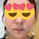 糸リフト BON BON CLINIC 銀座駅前本院 DAY 11 サムネイル用