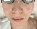 ピコスポット G MEDICAL ART クリニック 新宿院 DAY 0 サムネイル用