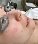 ピコスポット G MEDICAL ART クリニック 新宿院 DAY 0 サムネイル用
