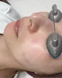 ピコスポット G MEDICAL ART クリニック 新宿院 DAY 0 サムネイル用