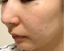 ピコスポット G MEDICAL ART クリニック 新宿院 DAY 1 サムネイル用