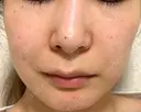 ピコスポット G MEDICAL ART クリニック 新宿院 AFTER サムネイル用