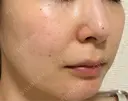 ピコスポット G MEDICAL ART クリニック 新宿院 DAY 9 サムネイル用