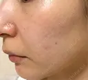 ピコスポット G MEDICAL ART クリニック 新宿院 DAY 9 サムネイル用