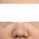 クマ治療 / ヒアルロン酸注入（目の下） ROOTS Clinic DAY 2 サムネイル用