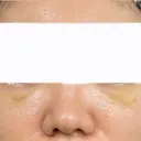 クマ治療 / ヒアルロン酸注入（目の下） ROOTS Clinic DAY 3 サムネイル用