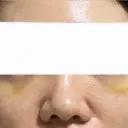 クマ治療 / ヒアルロン酸注入（目の下） ROOTS Clinic AFTER サムネイル用