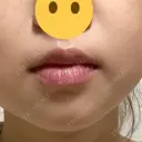 ボトックス（あご） / ボトックス（口角） ルラ美容クリニック 名古屋本院 AFTER サムネイル用