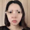 骨切り（あご） / 脂肪吸引（顔） アーククリニック DAY 17 サムネイル用