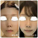 隆鼻術 / 鼻尖形成（切開） / 小鼻縮小（切開） / 軟骨移植 / 鼻柱下降・鼻唇角形成（猫手術） / ボトックス（エラ・小顔） / 毛穴洗浄（ハイドラフェイシャルなど） グローバルビューティークリニック 大阪院 DAY 154 サムネイル用