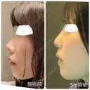 隆鼻術 / 鼻尖形成（切開） / 小鼻縮小（切開） / 軟骨移植 / 鼻柱下降・鼻唇角形成（猫手術） / ボトックス（エラ・小顔） / 毛穴洗浄（ハイドラフェイシャルなど） グローバルビューティークリニック 大阪院 DAY 154 サムネイル用