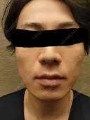 医療脱毛（顔） ミラクリニック 池袋院 AFTER サムネイル用