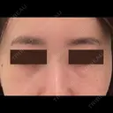 クマ治療 / 下まぶたたるみ取り / 下まぶたの脂肪取り APOLLO BEAUTY CLINIC DAY 18 サムネイル用