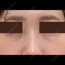 クマ治療 / 下まぶたたるみ取り / 下まぶたの脂肪取り APOLLO BEAUTY CLINIC DAY 19 サムネイル用