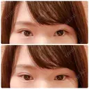 二重切開 / 上まぶたの脂肪取り 樹のひかり 形成外科・皮ふ科 AFTER サムネイル用
