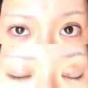 二重埋没 ROOTS Clinic DAY 7 サムネイル用