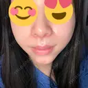小鼻縮小（切開） / 人中短縮 / 鼻翼挙上 Otus Clinic 【オータスクリニック】 AFTER サムネイル用