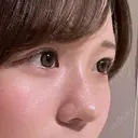 小鼻縮小（切開） / 鼻尖形成（非切開） ASTRA BEAUTY CLINIC DAY 677 サムネイル用