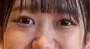 下まぶたの脂肪取り APOLLO BEAUTY CLINIC DAY 22 サムネイル用