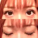 二重埋没 ROOTS Clinic DAY 8 サムネイル用