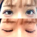 二重埋没 ROOTS Clinic DAY 10 サムネイル用
