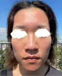 ダーマペン 共立美容外科 横浜院 DAY 0 サムネイル用