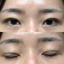 二重埋没 / クマ治療 / 上まぶたの脂肪取り / 下まぶたの脂肪取り NARU Beauty Clinic 【ナルクリ】 DAY 65 サムネイル用