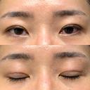 二重埋没 / クマ治療 / 上まぶたの脂肪取り / 下まぶたの脂肪取り NARU Beauty Clinic 【ナルクリ】 DAY 66 サムネイル用
