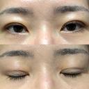 二重埋没 / クマ治療 / 上まぶたの脂肪取り / 下まぶたの脂肪取り NARU Beauty Clinic 【ナルクリ】 DAY 67 サムネイル用