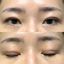 二重埋没 / クマ治療 / 上まぶたの脂肪取り / 下まぶたの脂肪取り NARU Beauty Clinic 【ナルクリ】 DAY 68 サムネイル用