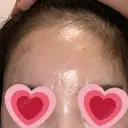 ヒアルロン酸注入（額） 藤・ナチュレ美容クリニック 銀座院 DAY 0 サムネイル用