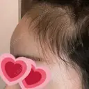 ヒアルロン酸注入（額） 藤・ナチュレ美容クリニック 銀座院 DAY 0 サムネイル用