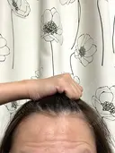 ボトックス（あご） / ボトックス（エラ・小顔） / ボトックス（眉間） / ボトックス（目尻） / その他（口元） TCB東京中央美容外科 高崎院 AFTER サムネイル用