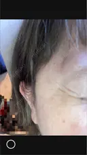 ボトックス（目尻） ROOTS Clinic AFTER サムネイル用