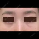 クマ治療 / 下まぶたたるみ取り / 下まぶたの脂肪取り APOLLO BEAUTY CLINIC DAY 22 サムネイル用