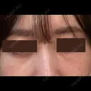 クマ治療 / 下まぶたたるみ取り / 下まぶたの脂肪取り APOLLO BEAUTY CLINIC DAY 23 サムネイル用