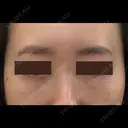 クマ治療 / 下まぶたたるみ取り / 下まぶたの脂肪取り APOLLO BEAUTY CLINIC DAY 25 サムネイル用