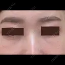 クマ治療 / 下まぶたたるみ取り / 下まぶたの脂肪取り APOLLO BEAUTY CLINIC AFTER サムネイル用