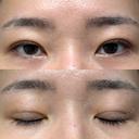 二重埋没 / クマ治療 / 上まぶたの脂肪取り / 下まぶたの脂肪取り NARU Beauty Clinic 【ナルクリ】 DAY 69 サムネイル用