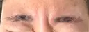 ボトックス（眉間） TCB東京中央美容外科 倉敷院 AFTER サムネイル用
