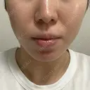糸リフト / 脂肪吸引（顔） EMMA CLINIC（エマクリニック） DAY 31 サムネイル用