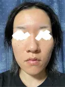 ダーマペン 共立美容外科 横浜院 AFTER サムネイル用