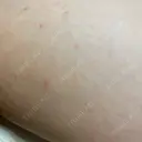 ボトックス（ふくらはぎ） DMTC CLINIC 日本橋院 DAY 1 サムネイル用