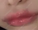 ヒアルロン酸注入（唇） ヴェリテクリニック 大阪院 DAY 1 サムネイル用