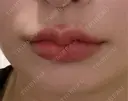 ヒアルロン酸注入（唇） ヴェリテクリニック 大阪院 AFTER サムネイル用