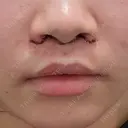 人中短縮 / 目尻切開 / タレ目形成・グラマラスライン（切開） / ボトックス（人中） / その他（鼻） ルラ美容クリニック 大阪本院 DAY 5 サムネイル用