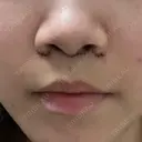 人中短縮 / 目尻切開 / タレ目形成・グラマラスライン（切開） / ボトックス（人中） / その他（鼻） ルラ美容クリニック 大阪本院 DAY 5 サムネイル用